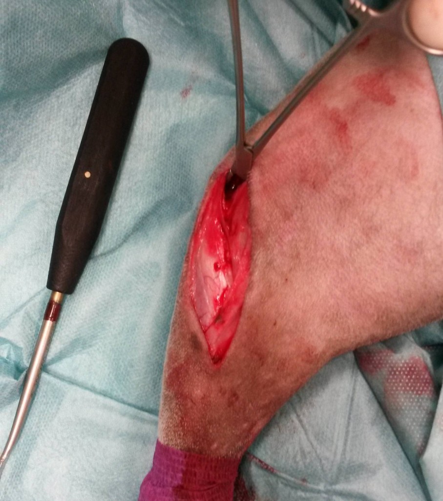 Photo 3 : Protection du tendon patellaire. Proximalement, l’articulation est ouverte en arrière du tendon patellaire. On peut ainsi placer un instrument pour protéger le tendon lors de l’incision.