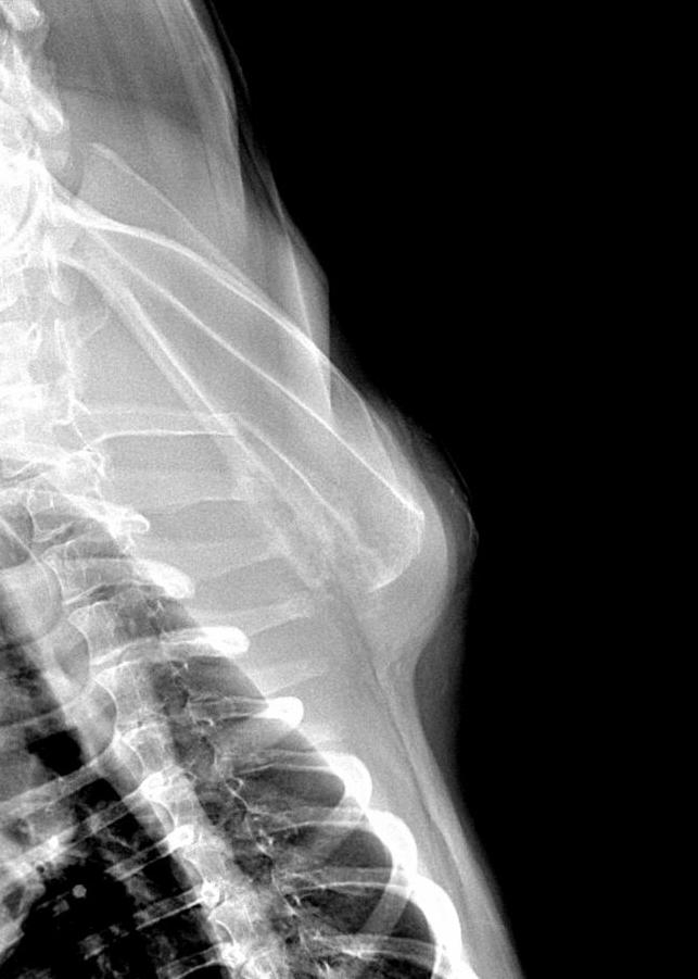 Fig. 2 : Radiographie ventro-dorsale de la scapula gauche. Une perte d’architecture osseuse est présente sur la portion caudo-ventrale de la scapula sur sa face interne.  Un gonflement important des tissus mous est présent en regard de la lésion osseuse. L’articulation scapulohumérale ne présente pas d’anomalie. 