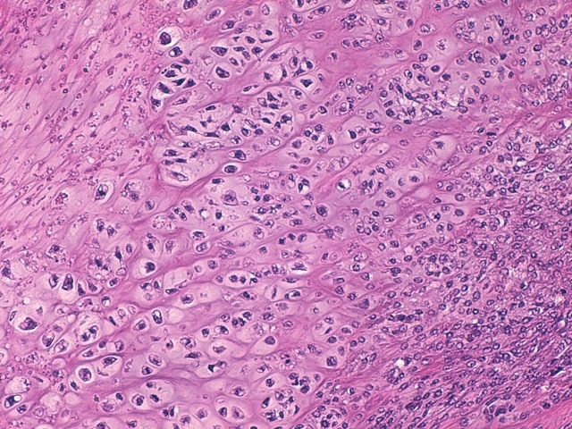 Fig. 9 : Coupe histologique du chondrosarcome (Hemalin-Eosine G*200). Un tissu néoformé densément cellulaire, ponctué de multiples plages à différenciation cartilagineuse est présent. Les atypies cytonucléaires sont marquées avec anisocytose et anisocaryose. Les figures de mitose sont régulièrement observées. La persistance de fragments de tissu osseux préexistant est notée.