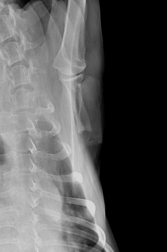 Fig. 11 : Radiographie de la scapula gauche 5 mois après scapulectomie partielle. Un léger remaniement osseux est présent au niveau des marges de section. Aucun signe radiologique de récidive tumorale n’est présent.